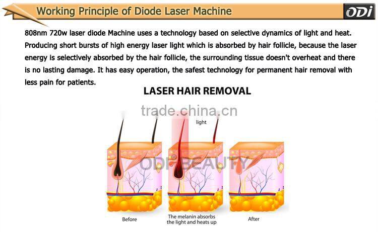 Bestselling cheap laser hair remover diode laser system OD-LS808