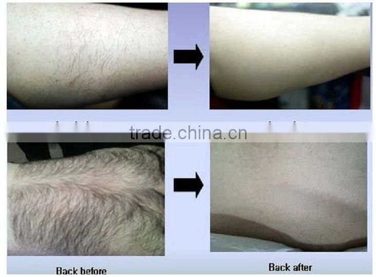 skin rejuvenation/SHR 808/810nm laser diode 10w