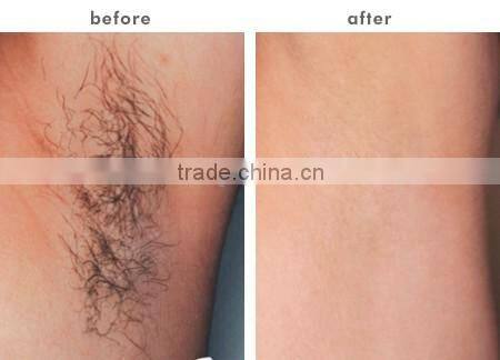 2016 most effective ipl elight shr,automatic penis massager for ipl beauty salon equipment made in China