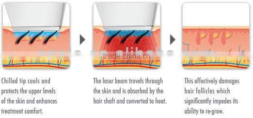 Apolomed 808 diode laser hair removal machine skin rejuvenation laser diode