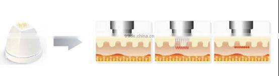 microneedle fractional rf fractional rf / fractional rf skin / micro needle fractional rf machine