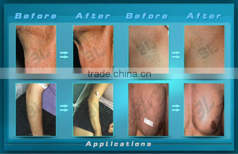 HR FHR SR diode aser hair removal system