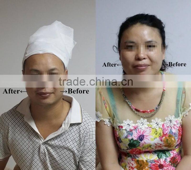 GLM Hifu ultrasonic face lift machine home use