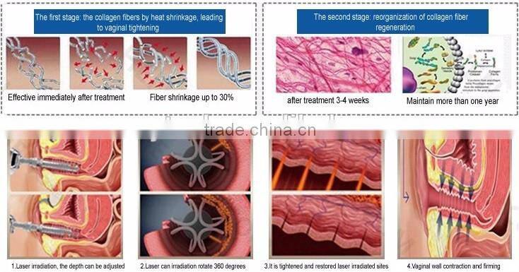 professional fractional co2 laser vagina co2 fractional laser VH613
