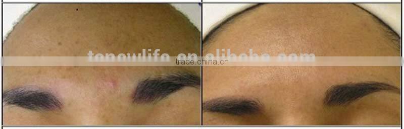 NL-SPA900 Facial Care Skin New Water Dermabrasion Diamond Microdermabrasion Machine acne scars treatment