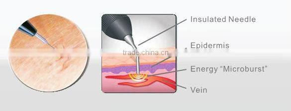 Pain Free skin mole removal machine