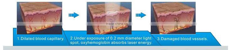 Hot selling factrory price vascular removal diode laser machine