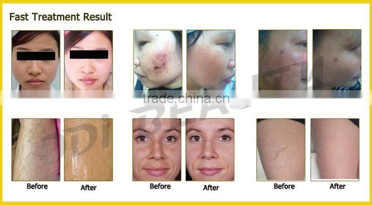 (OD-Mini70) Distributors wanted!! CE approval beauty machine hair removal ipl system