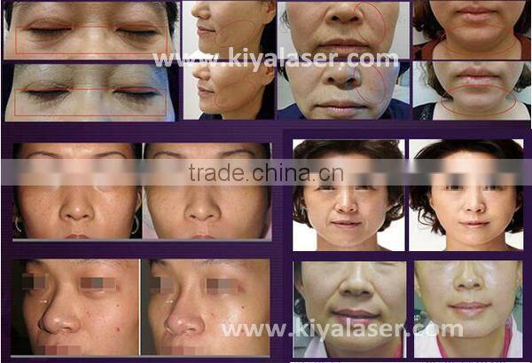 Distributor price hifu for skin tightening