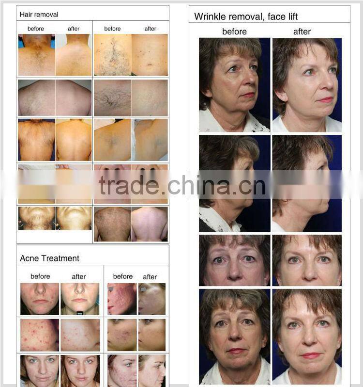 Professional portable skin rejuvenation ipl rf machine