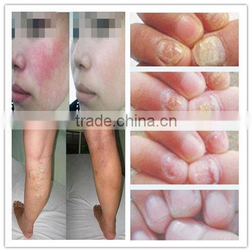 laser hair removal beauty machine /nail fungus P003