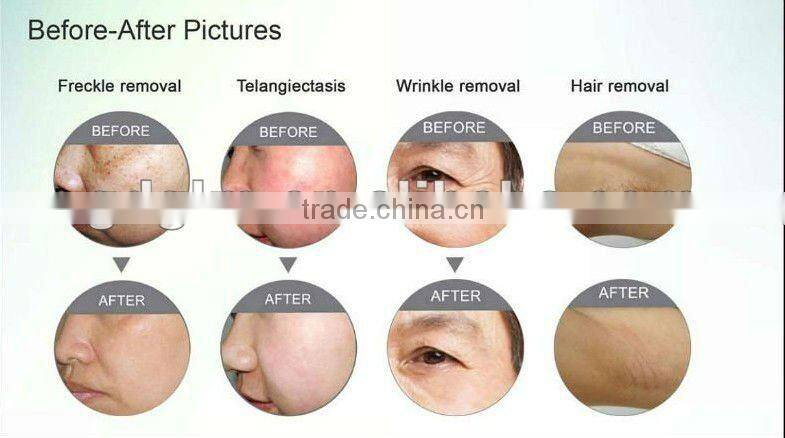 IPL Wrinkle&hair removal laser tatoo elimination beauty equipment