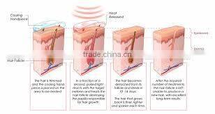 808 nm Diode Laser Depilatory Beauty Equipment for Permanent Hair Removal