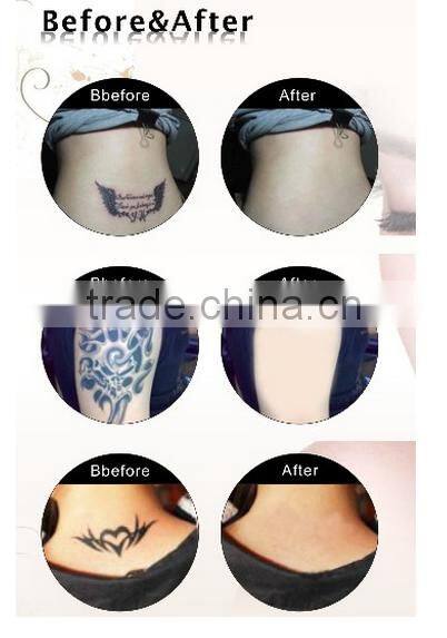 Tattoo Removal Nd yag laser Beauty Equipment For Salon Using