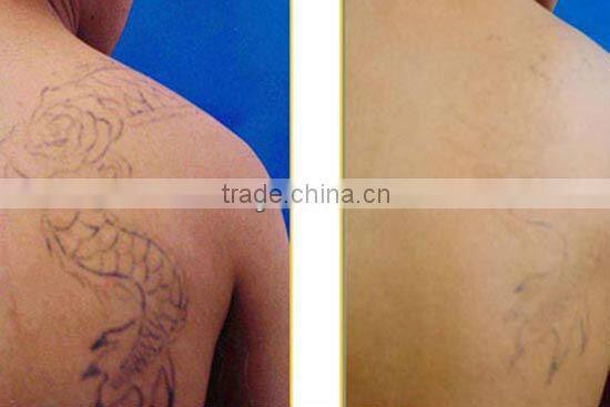 D005 cosmetology yag laser machine remove tattoo