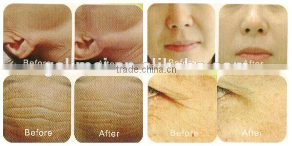 Monopolar rf desktop skin tightening machine for home use