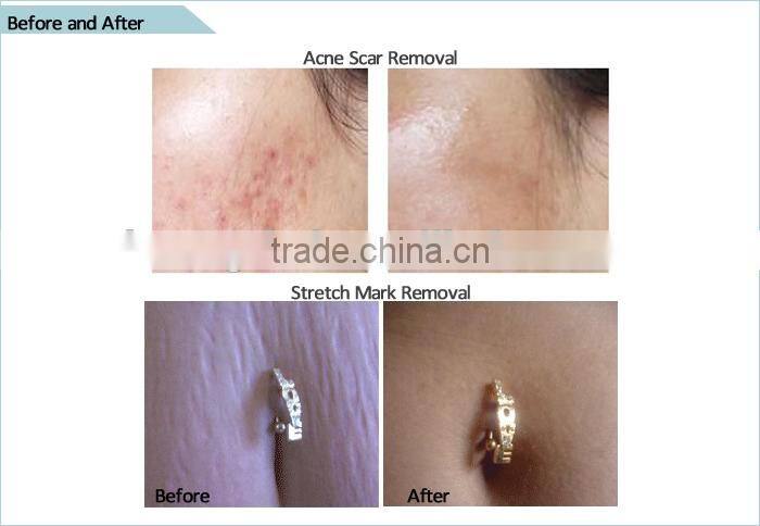 dts 192 needles derma roller