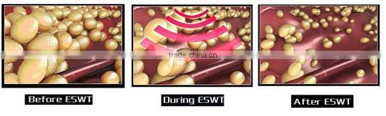 Newest designed extracorporeal shock wave slimming system