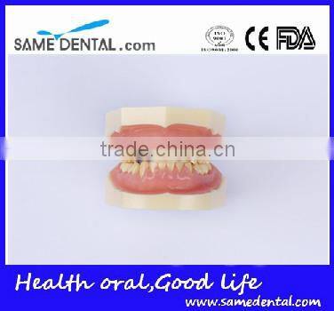 Dental Moderate Periodontal Disease Model Teaching Demonstration