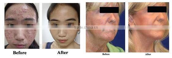 Top Products 2015 Professional Upgrade PDT LED Skin Tightening Beauty Equipment