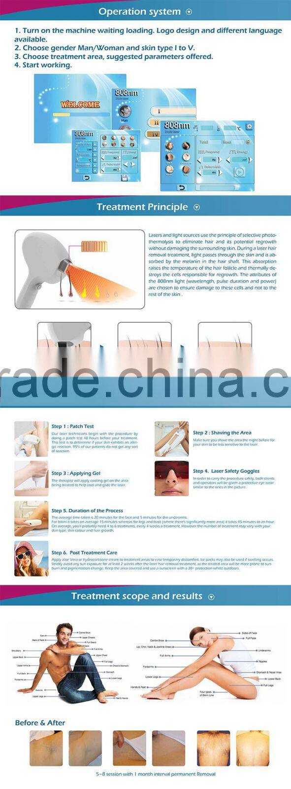 Easy to use CE FDA approved 600W output full body laser hair removal devices with 3 years warranty