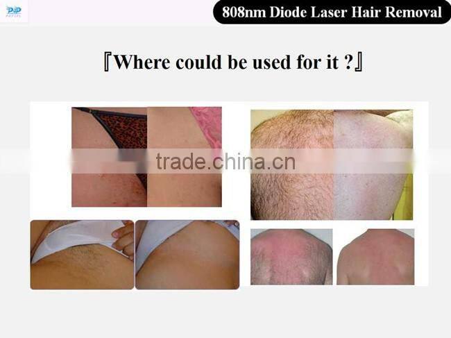 808nm Diode Laser machine for hair removal laser hair removal machine