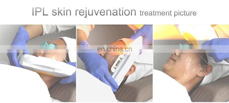 IPL wrinkle removal laser home use 2 in 1 Elight IPL RF permanent hair remover