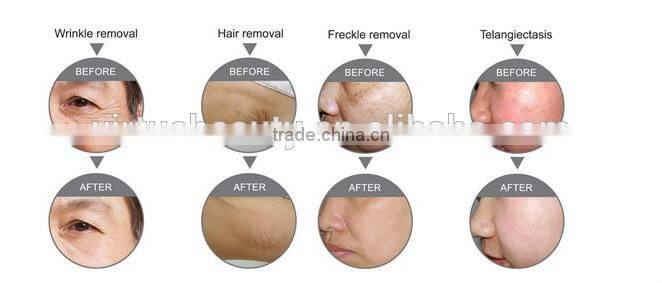 2016 hot sell alexandrite laser machines nd yag laser beauty machines