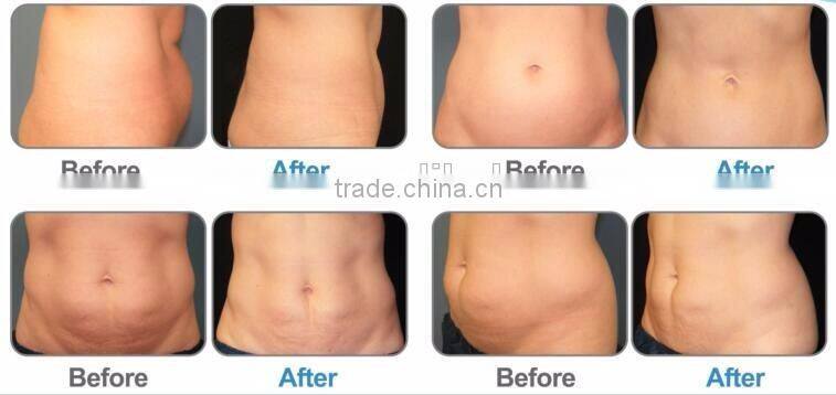 Wholesale Alibaba Mini Portable Cryotherapy Machine for Burning Fat