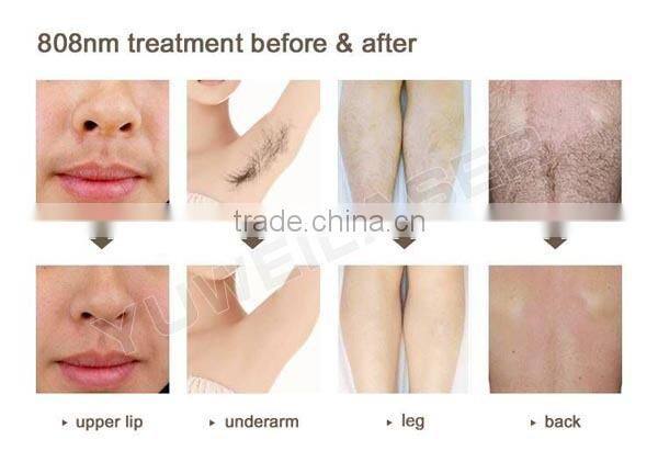 2016 Hot 808nm diode laser permanent hair removal/