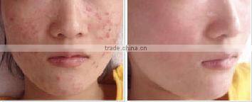 Portable Intense Pulsed Light IPL Acne/Hair Removal Device