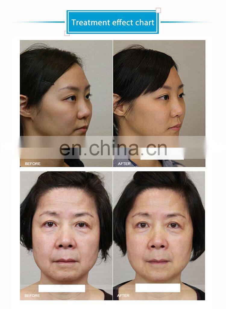 Ready to ship!!! Mini Ultrasound Skin Lifting HI FU Rejuvenation Vaginal Tightening Machine