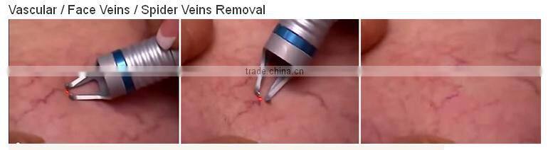 professional diode laser blood vessels removal spider vein / vascular removal equipment