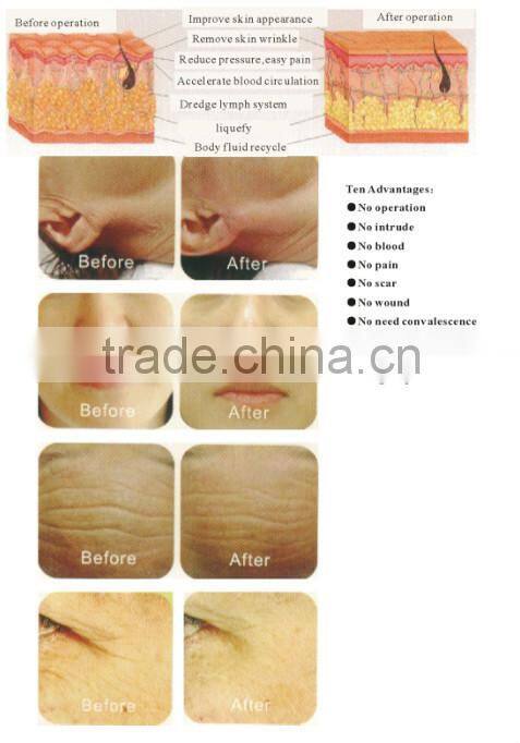 Potable wrinkle removal face lifting RF equipments