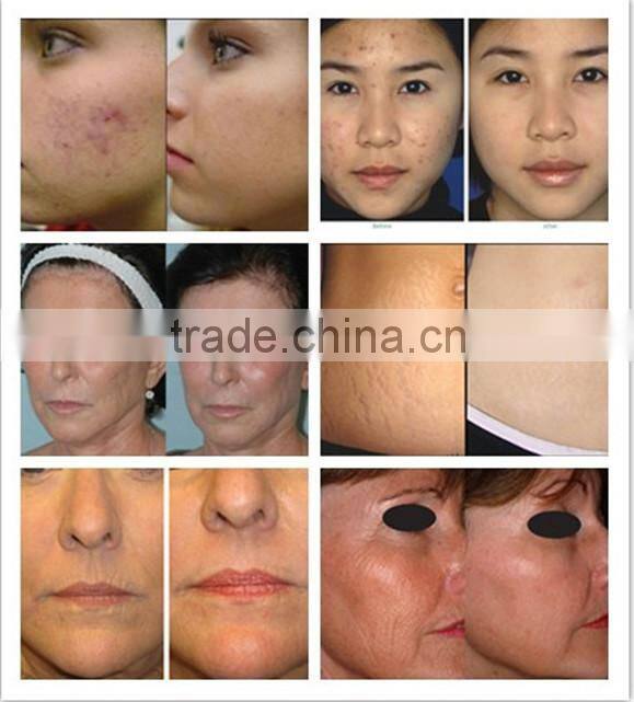 Multifunction skin tightening machine whitening products rejuvi tattoo removal SALE !