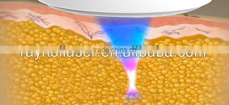 Liposonix 2016 Machine Portable Eye Bag Removal