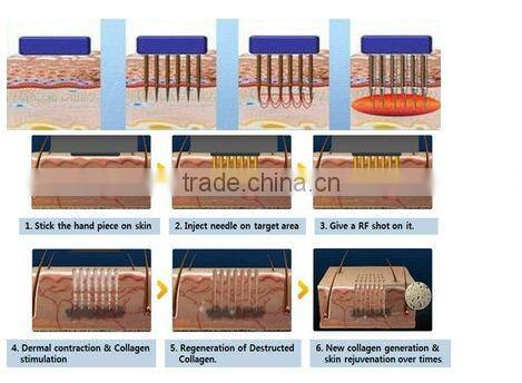 2 professional treatment handles radiofrecuencia fraccionada