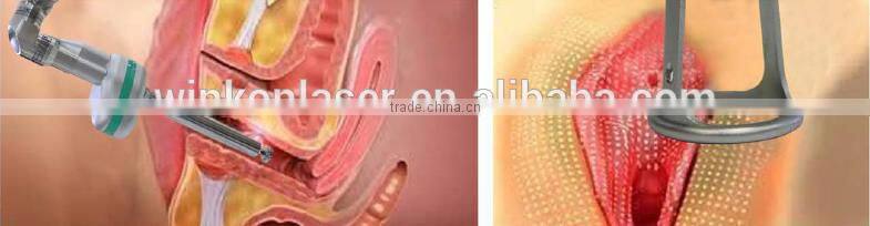 vaginal tightening machine / laser equipment co2 fractional / vaginal equipment