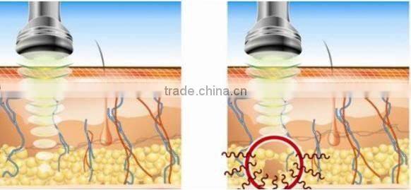 Tripolar Multipolar Bipolar RF +cavitation