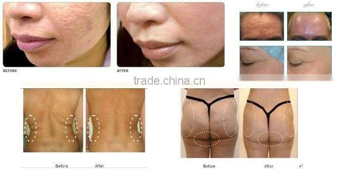 korea rf skin tightening machine
