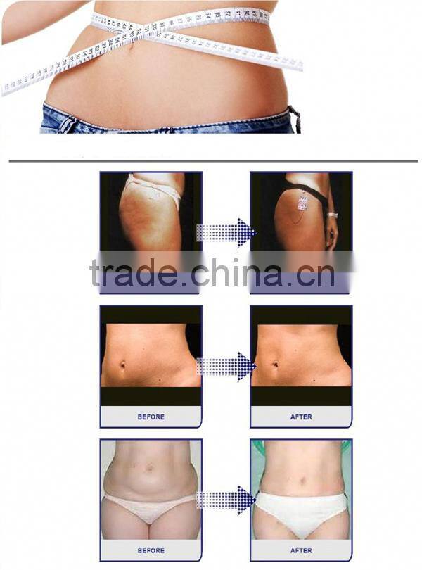 Best choice home cryolipolysis machine slimming system cryolipolysis machine in usa