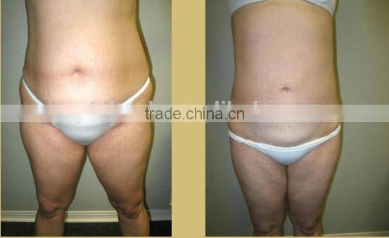 Cryo kim 8 slim system cryotherapy machine whole body weight loss