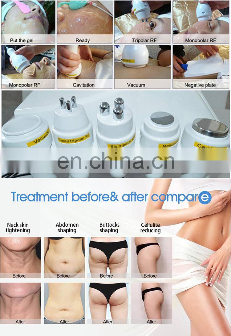 New Vacuum Slimming Fat Rf Liposlim Cavitation Machine