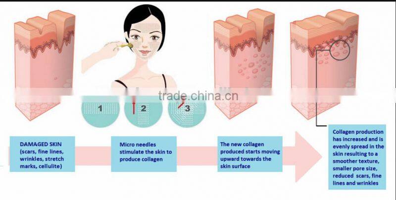 Best design Zgts Micro Needling Derma Roller Meso Roller for skin care,scar removal,hair loss - L006