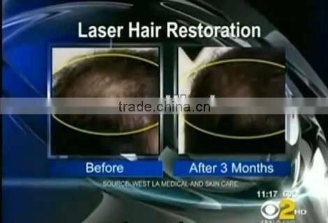 650nm diode laser hair regrowth beauty machine