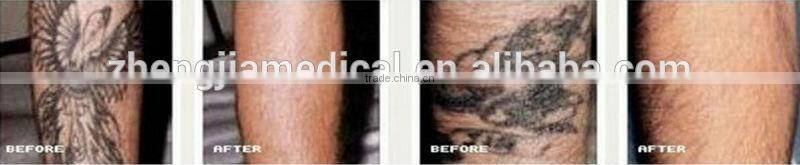 vertical q switch nd yag laser pigment and tattoo removal device