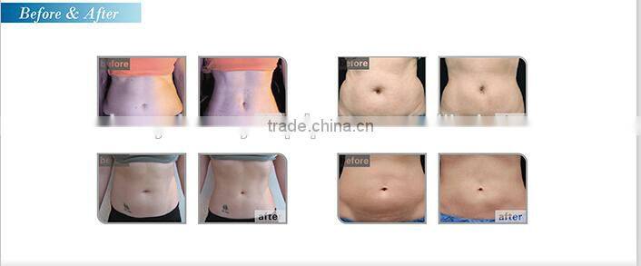 World most advanced latest HIFUSHAPE hifu transducer for body slimming body shaping weight loss