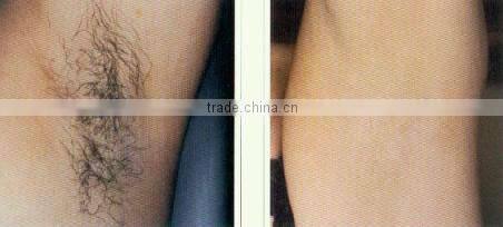 long pulse nd yag laser hair removal HS 280 long pulse nd yag laser hair removal machine laser by shanghai apolo