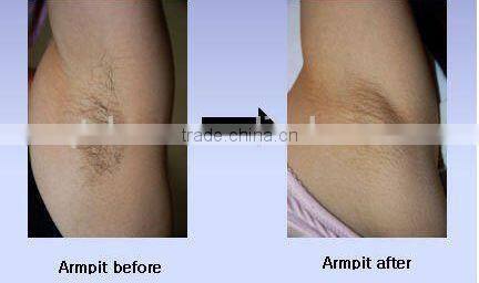 2014 808nm/810nm skin rejuvenation /hair removal laser soprano