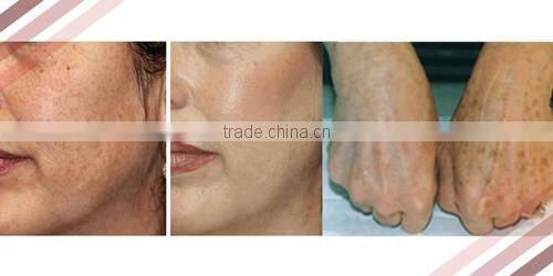 Newest !! venus mini ipl machine/e light device with CE,ISO,TUV